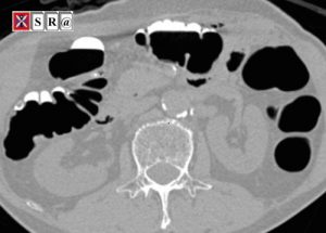 Improving the Quality of Electronic Cleansing of Colorectal CT Images Using a Hybrid Method