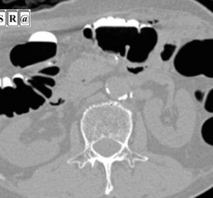 Improving the Quality of Electronic Cleansing of Colorectal CT Images Using a Hybrid Method