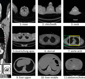 DEEP LEARNING BASED SEGMENTATION OF BODY PARTS IN CT LOCALIZERS ANDAPPLICATION TO SCAN PLANNING