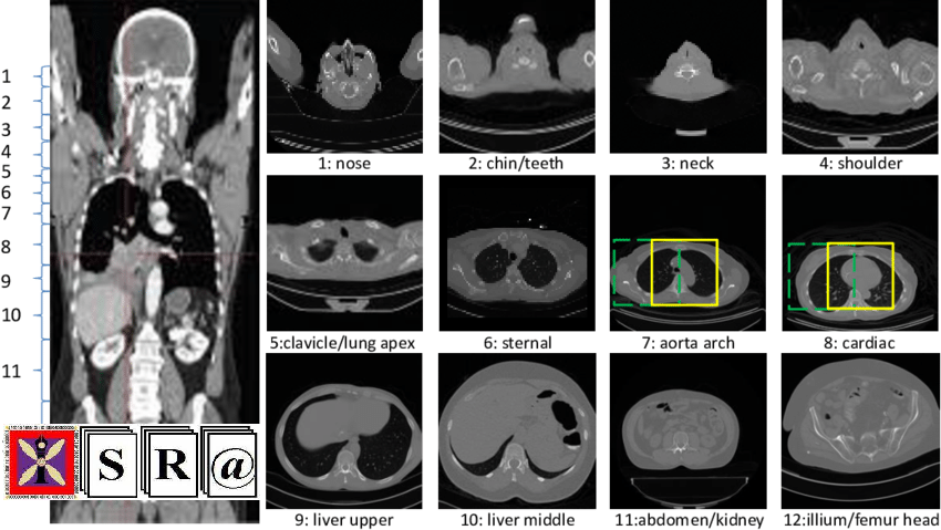 DEEP LEARNING BASED SEGMENTATION OF BODY PARTS IN CT LOCALIZERS ANDAPPLICATION TO SCAN PLANNING