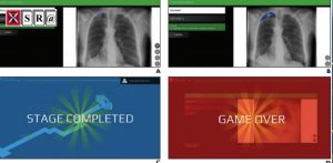 Gamification of Electronic Learning in Radiology Education to Improve Diagnostic Confidence and Reduce Error Rates