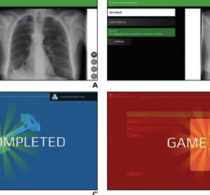 Gamification of Electronic Learning in Radiology Education to Improve Diagnostic Confidence and Reduce Error Rates